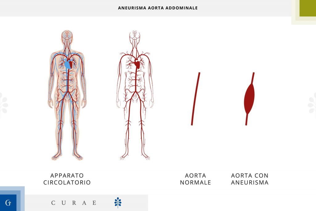 aneurisma aorta addominale