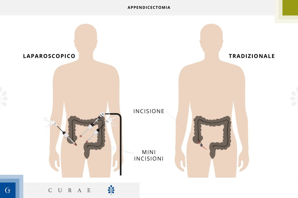 appendicectomia laparoscopica