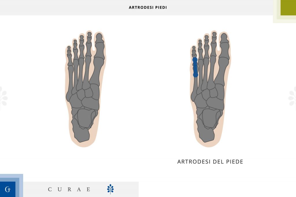 artrodesi piede