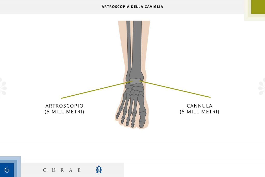 artroscopia caviglia