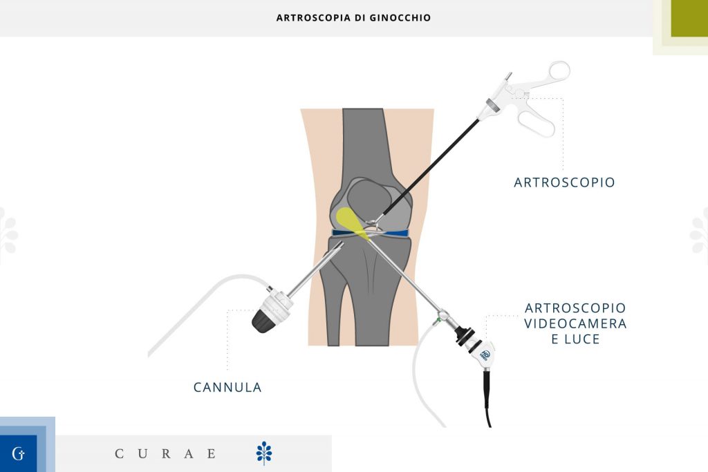 artroscopia ginocchio