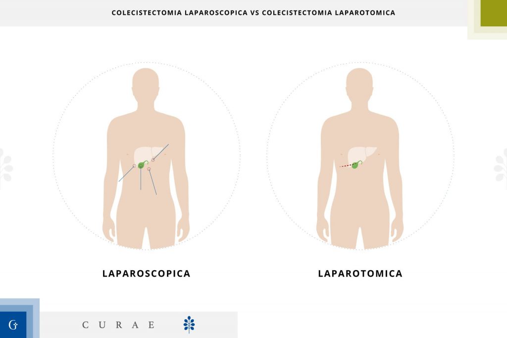 colecistectomia laparotomica