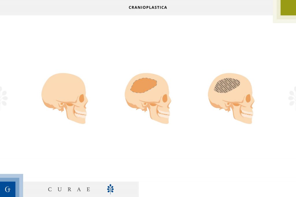 cranioplastica