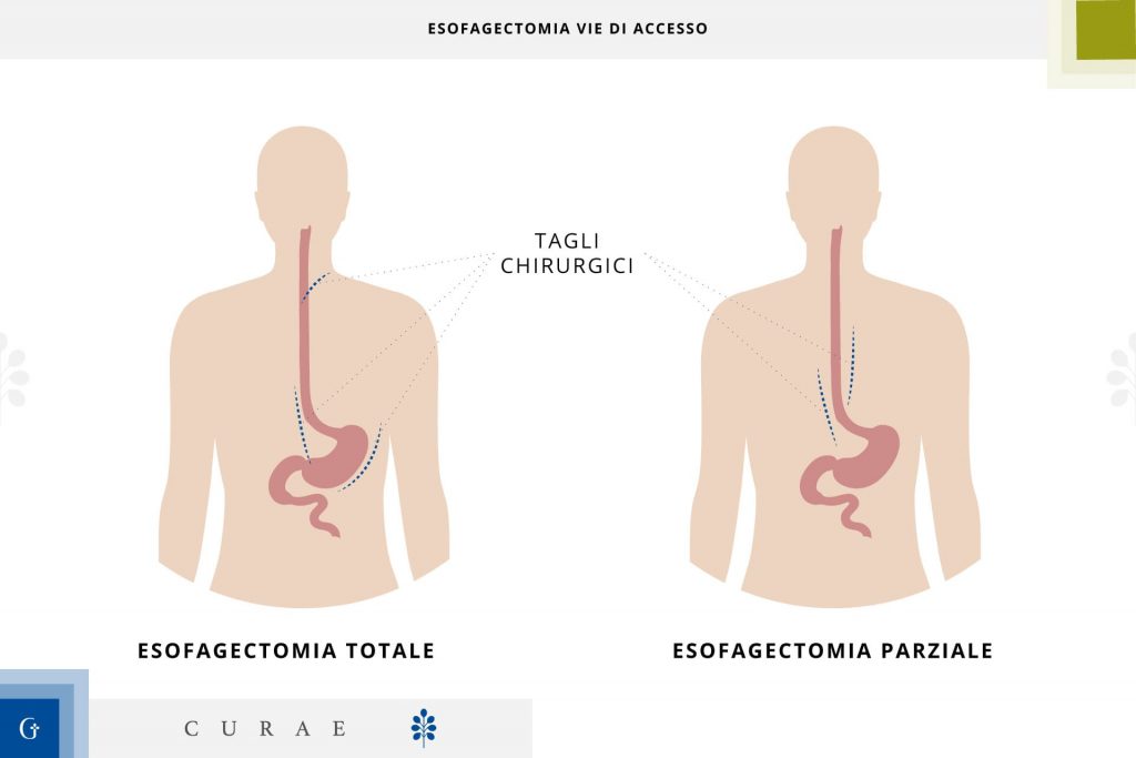 esofagectomia transiatale