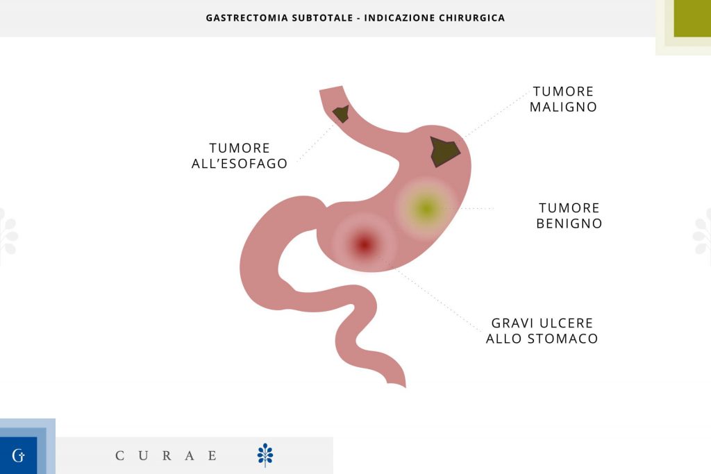 gastrectomia subtotale