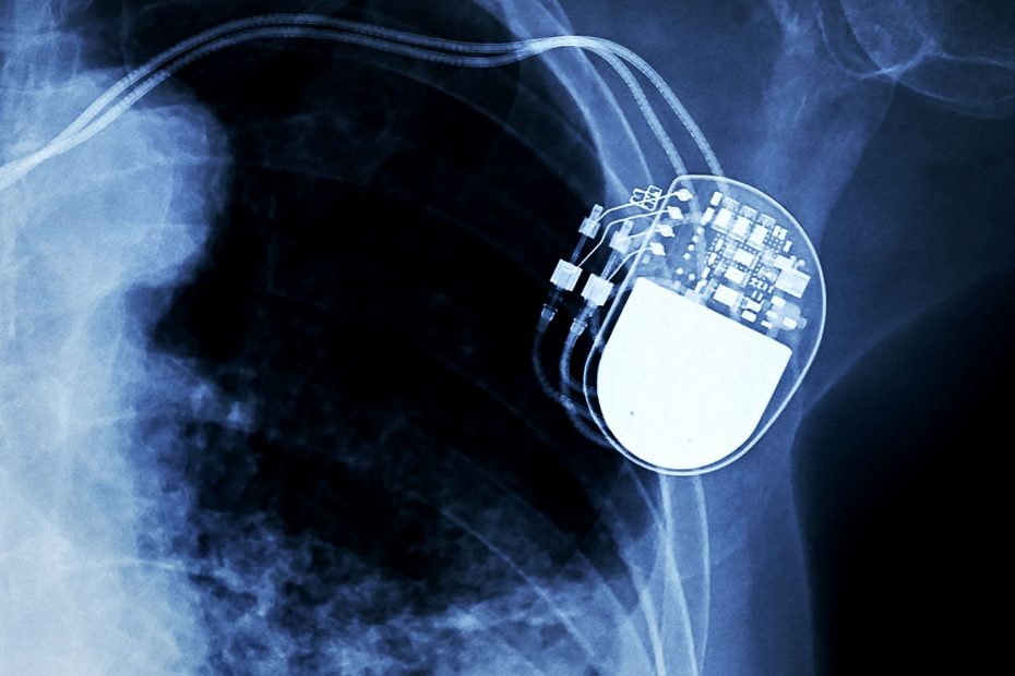 impianto pacemaker
