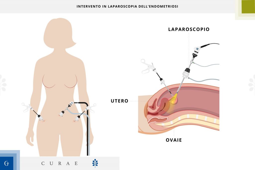 laparoscopia endometriosi