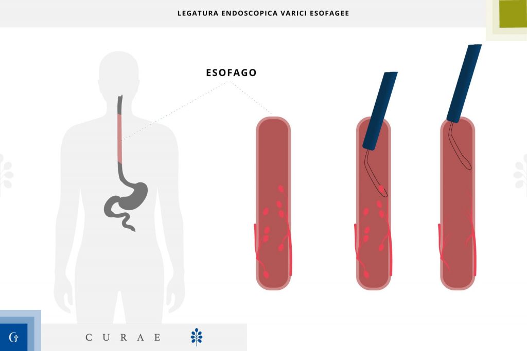 legatura endoscopica delle varici esofagee