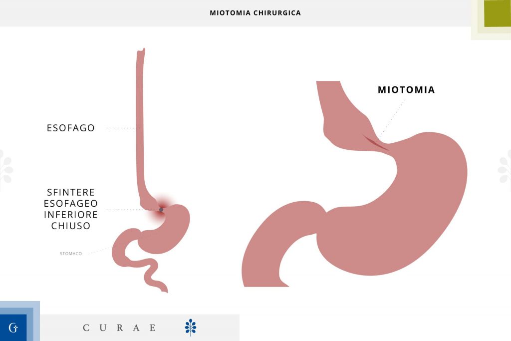 miotomia esofagea