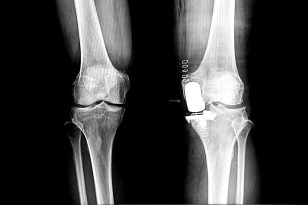 protesi ginocchio roma