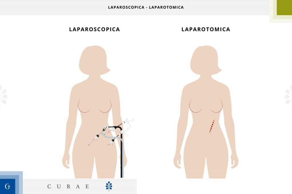 splenectomia laparoscopica