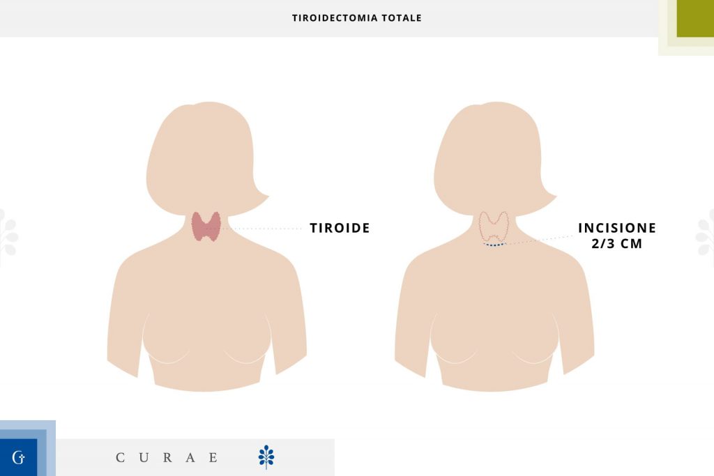 tiroidectomia totale