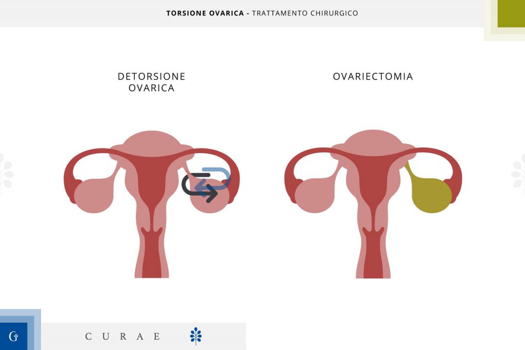 torsione ovarica intervento