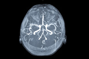 angiografia cerebrale roma