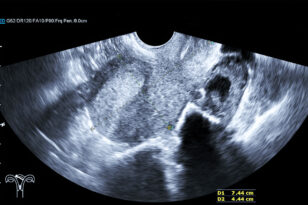 ecografia endocavitaria roma