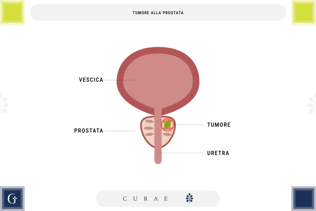 adenocarcinoma prostatico