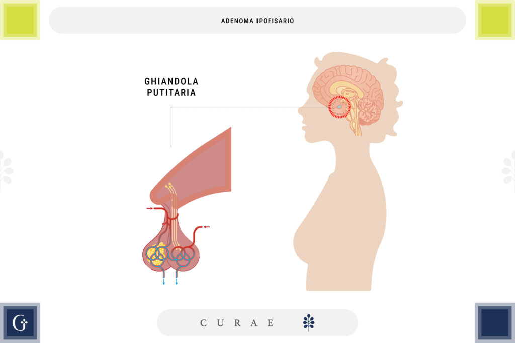 adenoma ipofisario sintomi neurologici