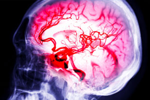 aneurisma cerebrale intervento roma