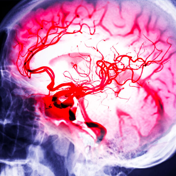 aneurisma cerebrale intervento roma