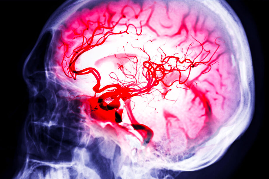 aneurisma cerebrale intervento roma