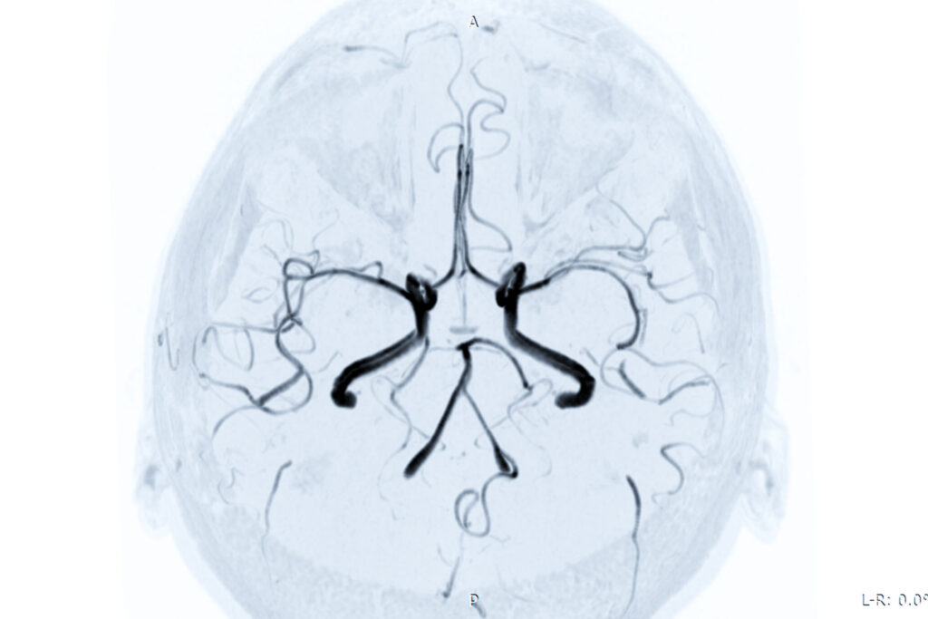 angio RM distretto vascolare intracranico