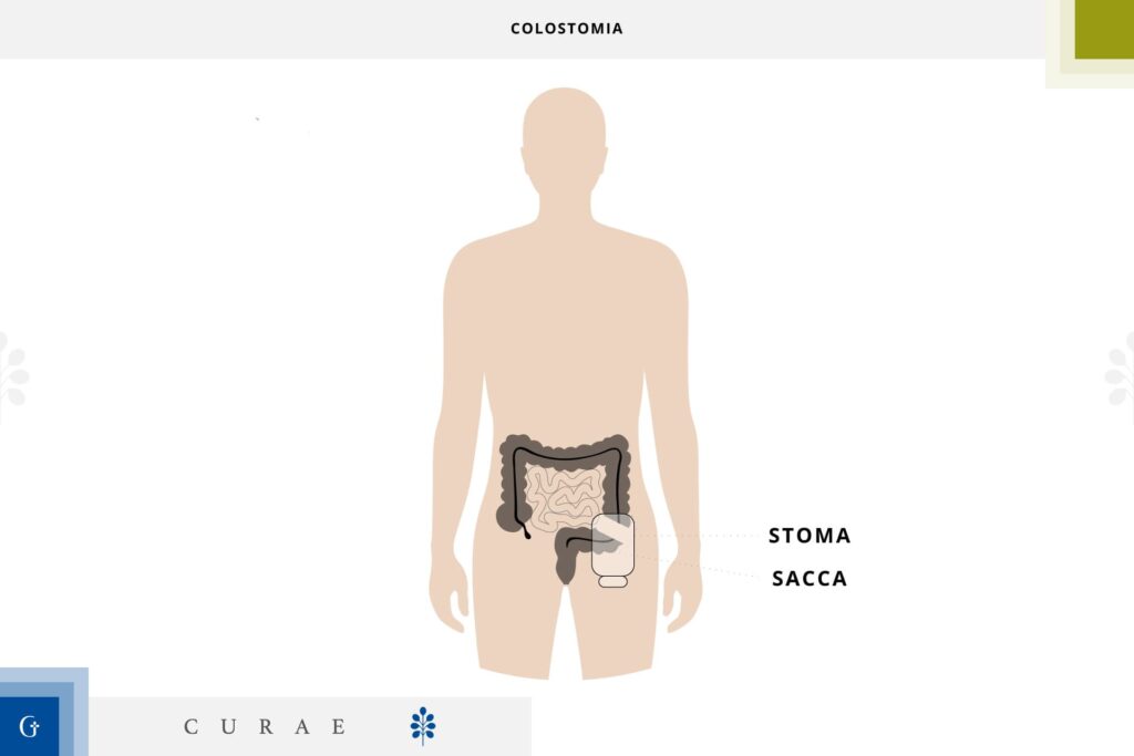 colostomia