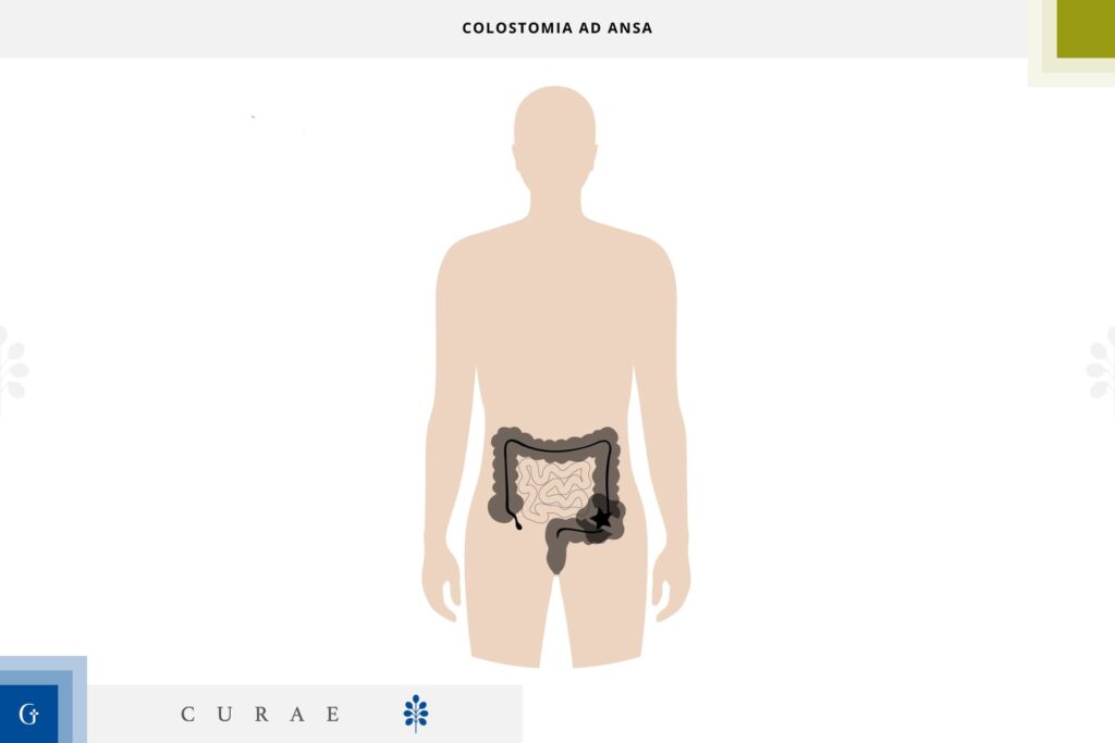 colostomia temporanea