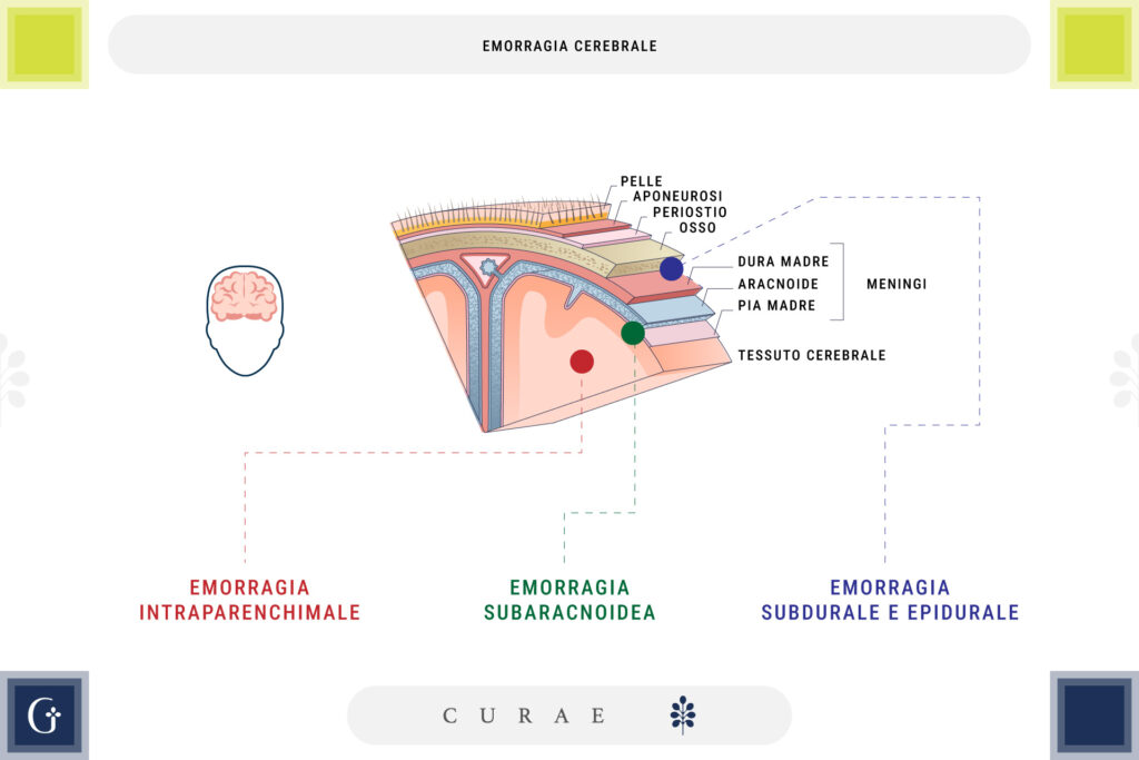 emorragia cerebrale
