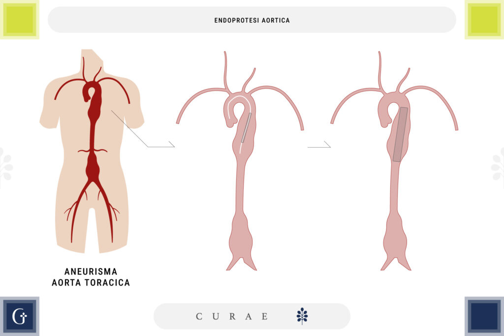 endoprotesi aortica