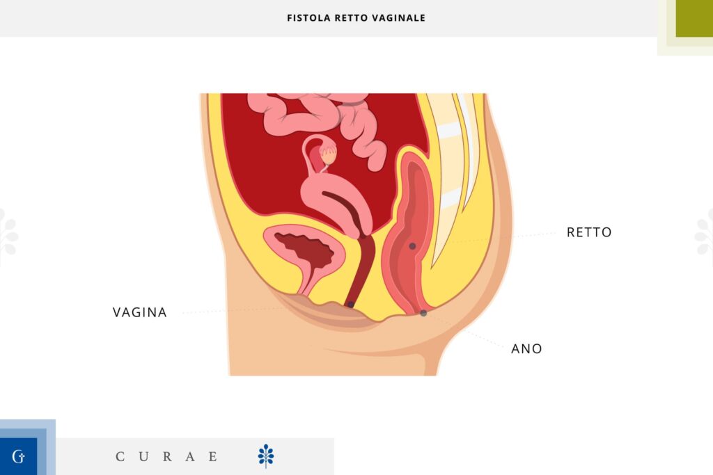 fistola retto vaginale