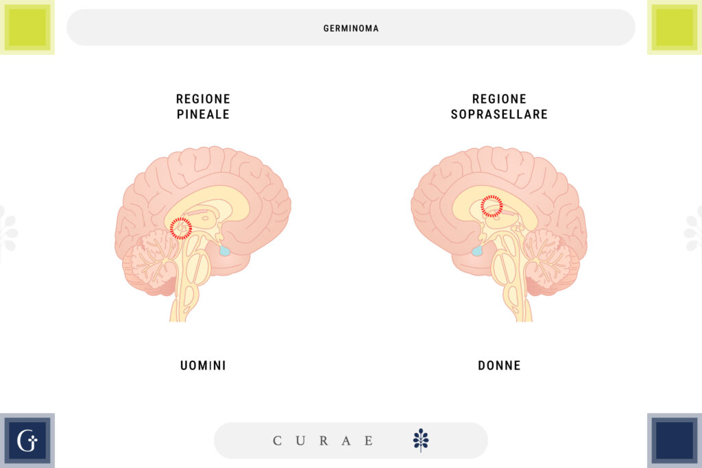 germinoma