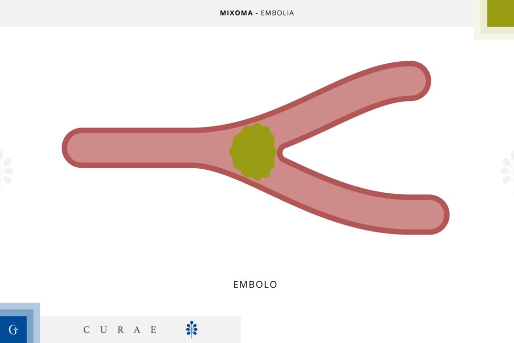 mixoma cardiaco