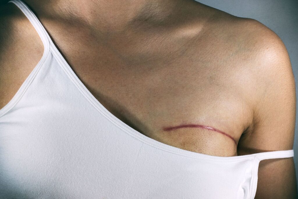 ricostruzione seno dopo radioterapia