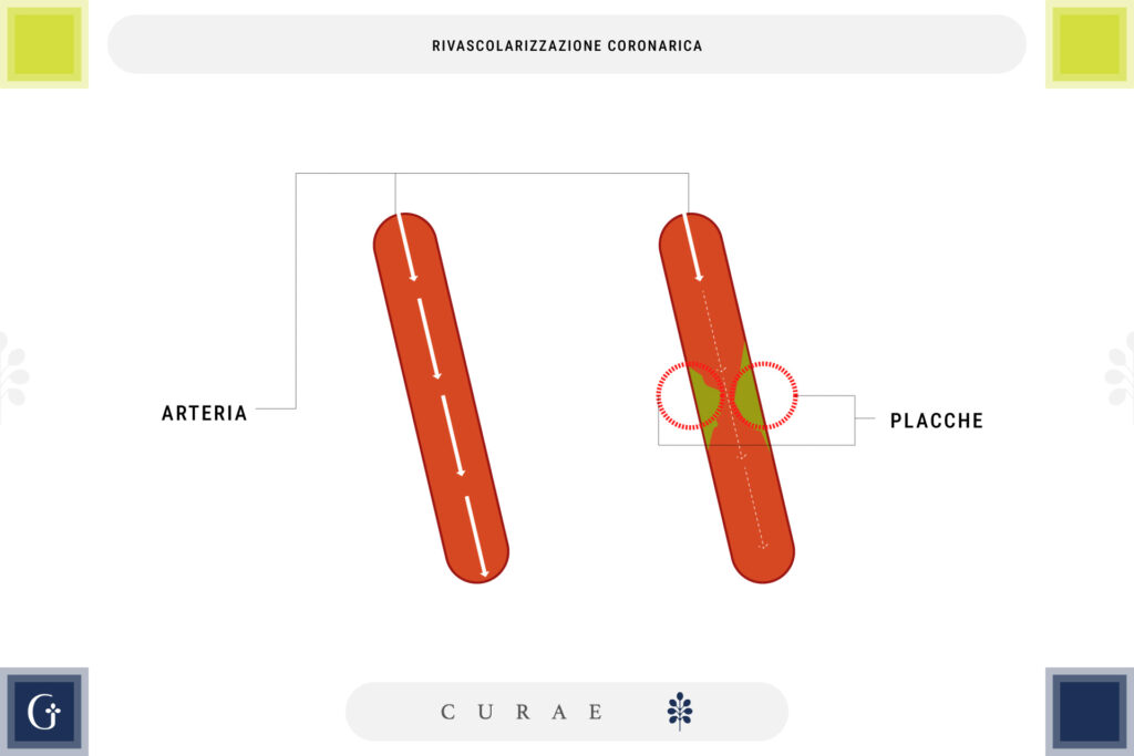 rivascolarizzazione coronarica