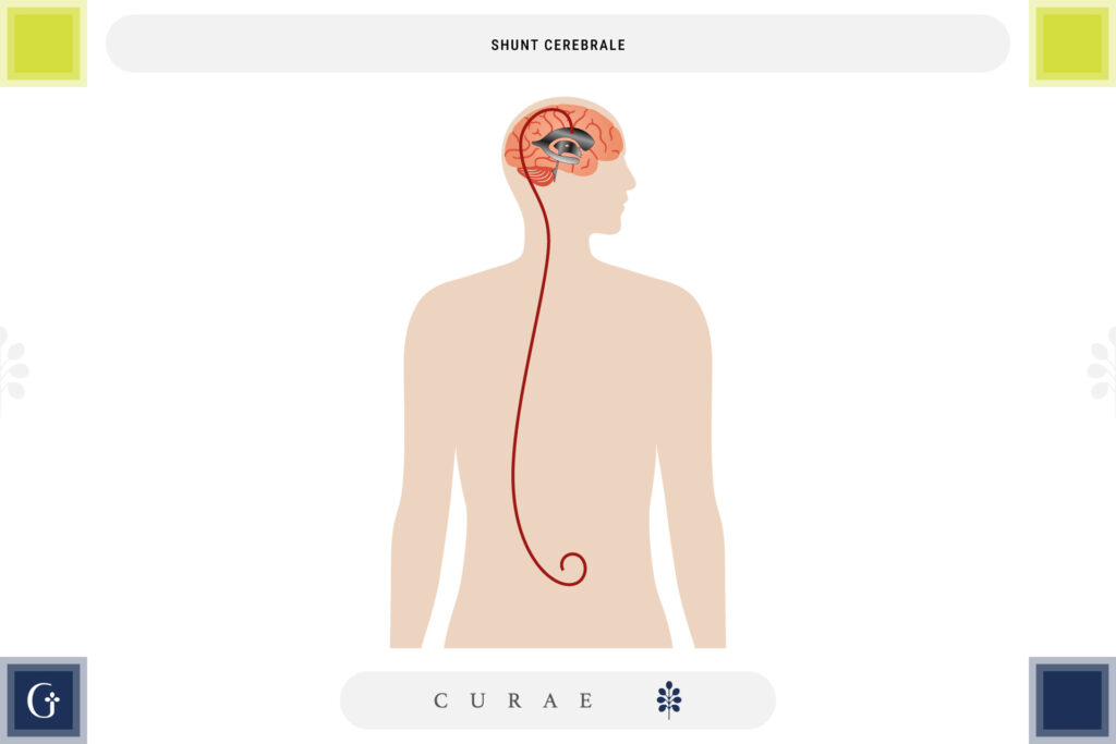 shunt cerebrale