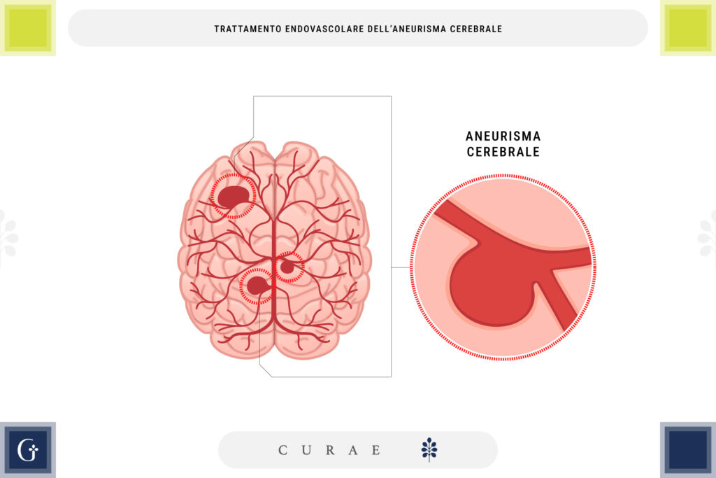 trattamento endovascolare aneurisma cerebrale