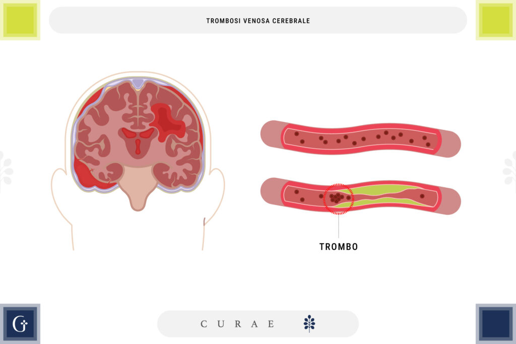 trombosi venosa cerebrale